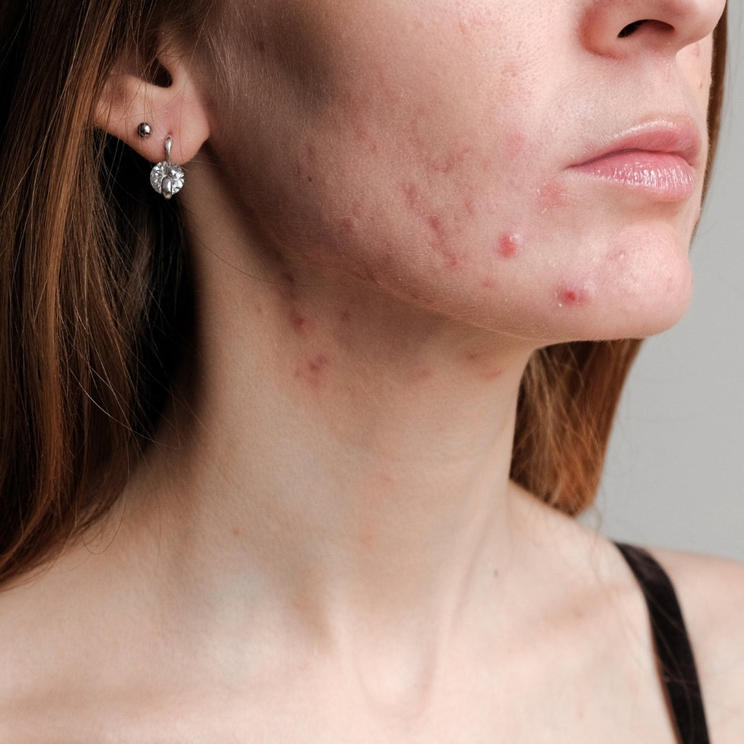 Foto de mujer joven con acné, BLOOM, tipos de acné durante la menstruacion