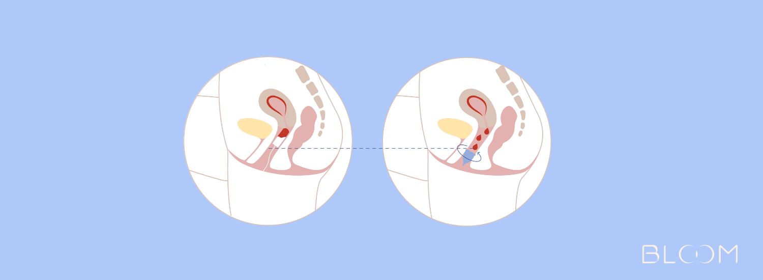 Gráfico diferencias entre copa menstrual vs. tampón